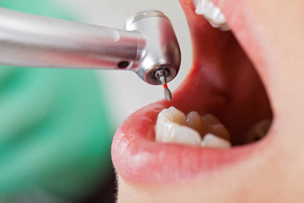 Best Chipped Tooth Repair Near Me  in Meggett, SC